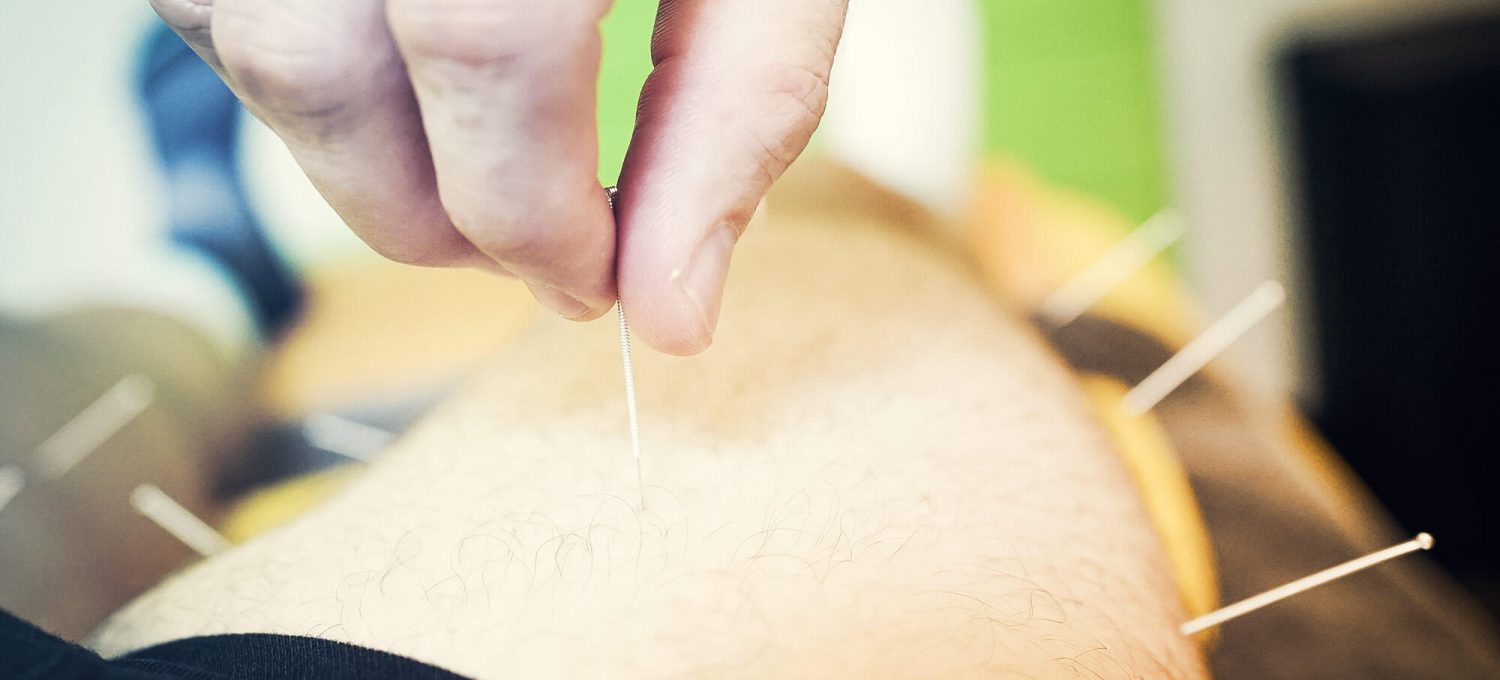 Anbringen der Dry Needling Nadeln