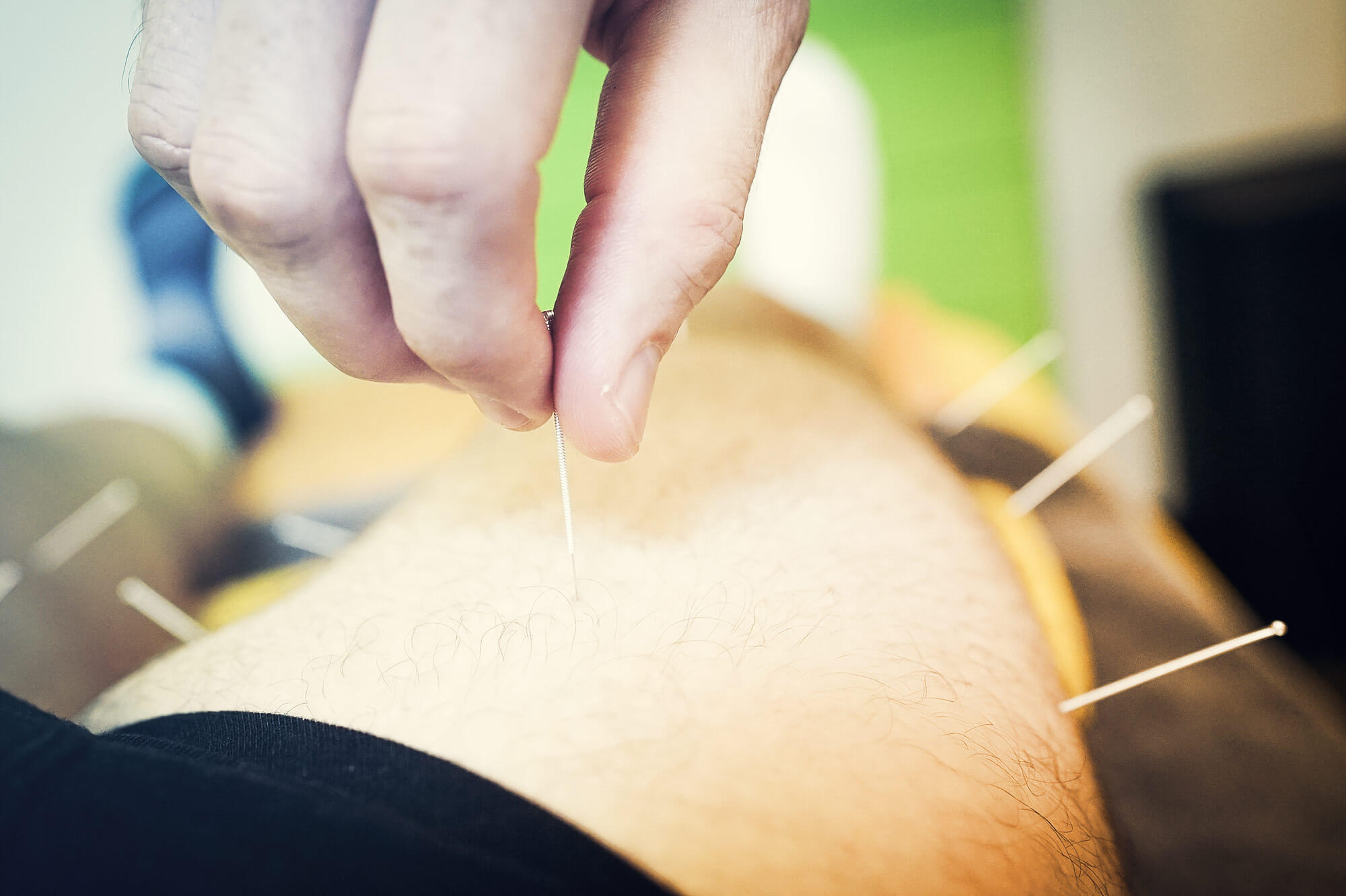 Anbringen der Dry Needling Nadeln