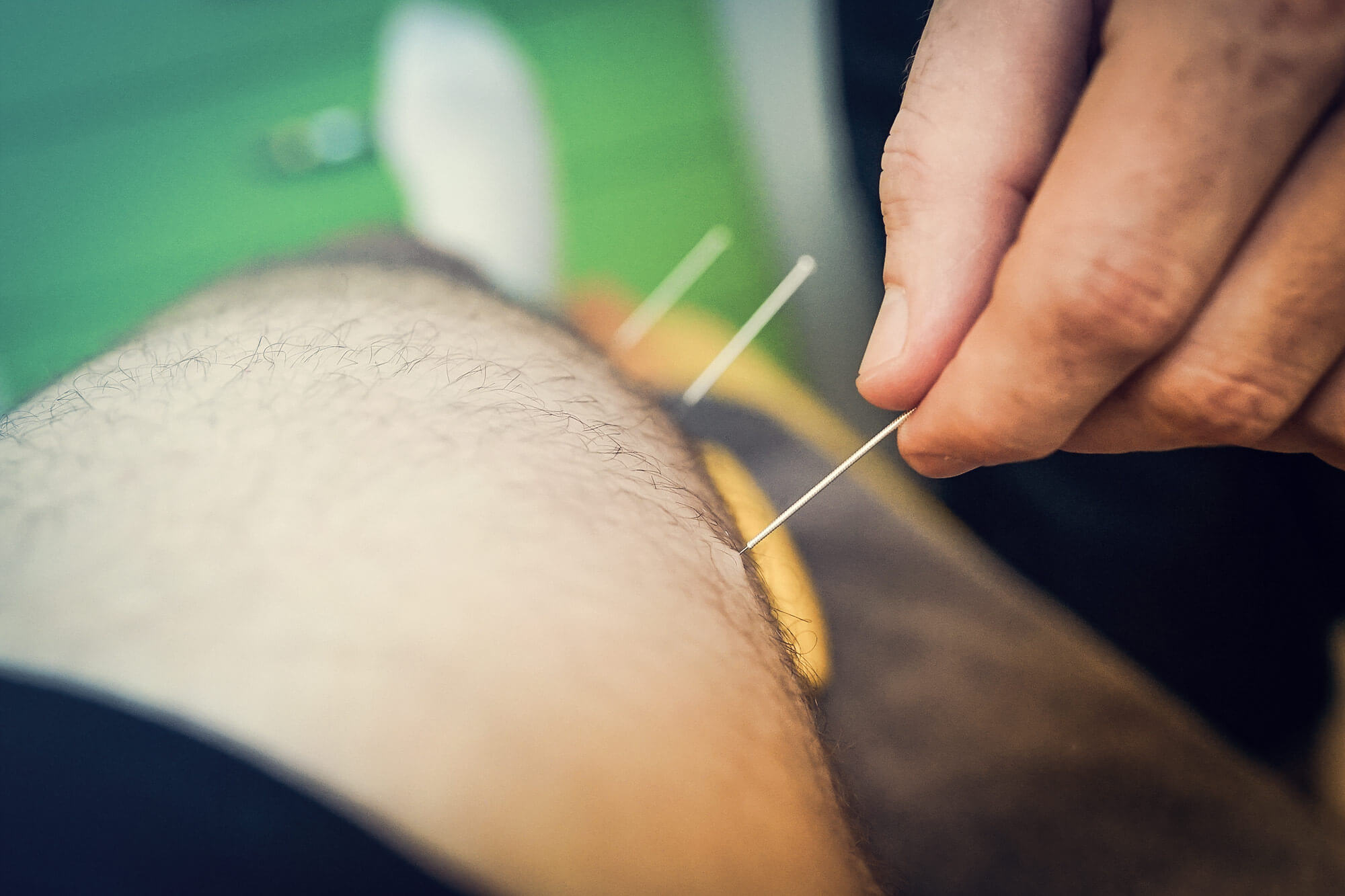 Entfernen der Dry Needling Nadeln